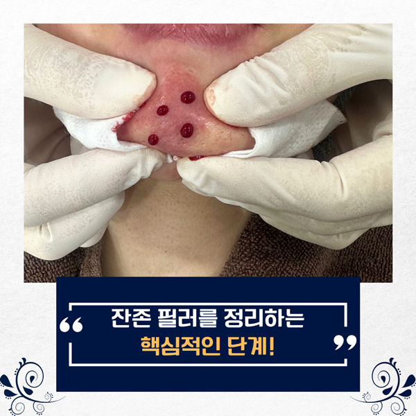 잔존필러 제거 과정