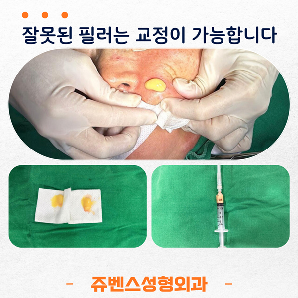 잘못된 필러 교정 가능