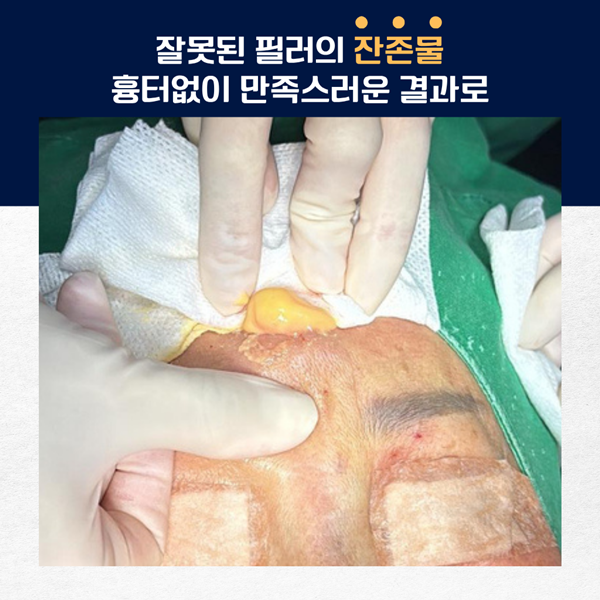 잔존물 흉터없이 제거합니다